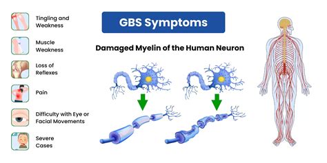 what is gbbs.